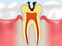 C2【象牙質のむし歯】