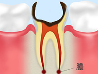 C4【歯根まで達したむし歯】